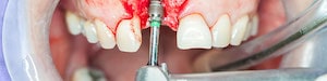 Dental Impant Injury